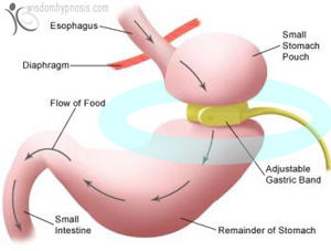 gastric-band-stomach300x227